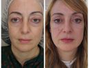 ano blepharoplastike