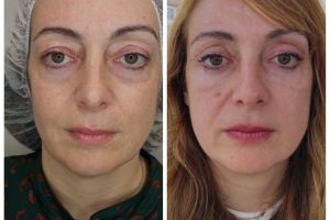 ano blepharoplastike