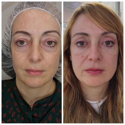 ano blepharoplastike