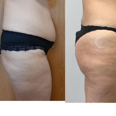 apotelesma mini koilioplastikes kai mataphora lipous stous gloutous1