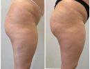 diorthose asymmetrias glouton apo yalouroniko me chrese autologou lipous2