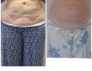 diorthose chalaroses koilias me laser minimal invasive
