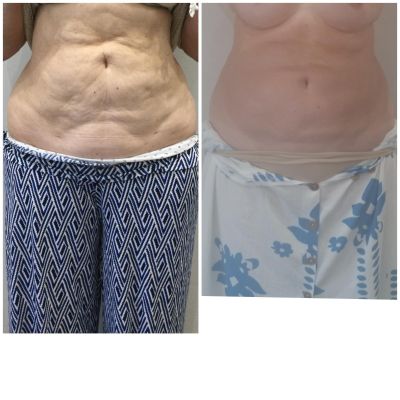 diorthose chalaroses koilias me laser minimal invasive