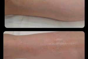 therapeia dyschromion me laser