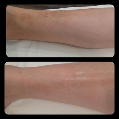 therapeia dyschromion me laser