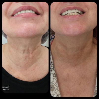 therapeia laimou me skinbooster